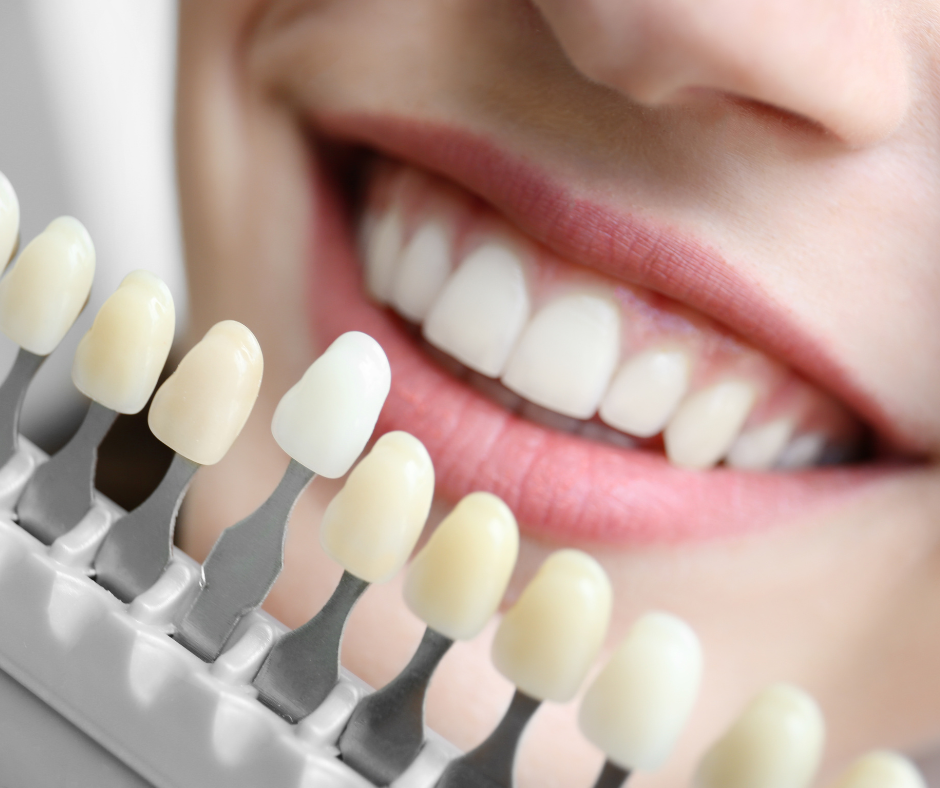 Blanqueamiento dental antes del verano en Centro Odontológico Alcobendas